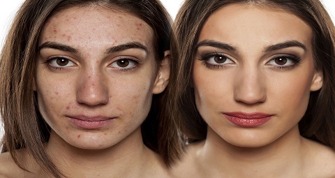 Pimples Treatment Before and After