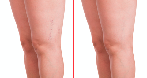Varicose veins before and after
