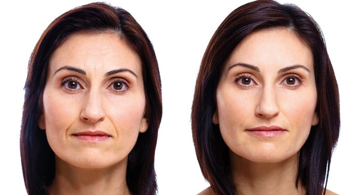 Anti Wrinkle Injections before and after