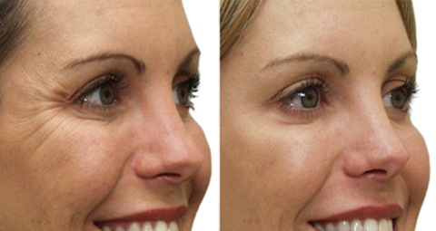 Anti Wrinkle Injections before and after