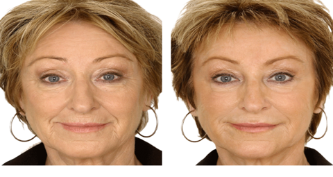 Anti Wrinkle Injections before and after