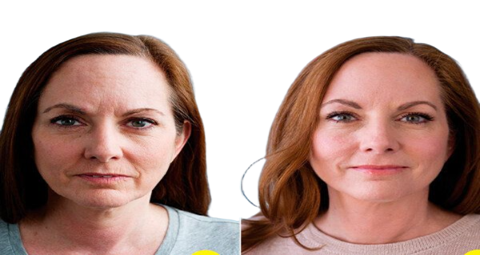 Anti Wrinkle Injections before and after