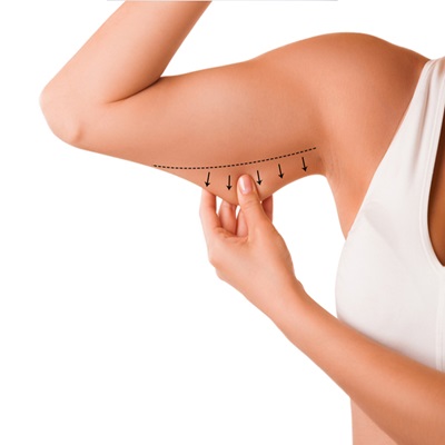 Arm lift Surgery Cost in Dubai | Best Prices