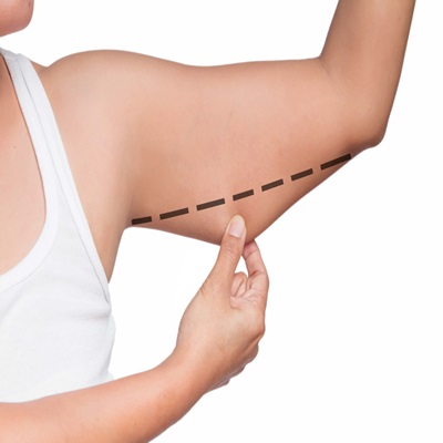 Arm lift surgery in Dubai