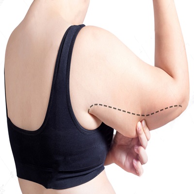 Arm lift surgery in Dubai