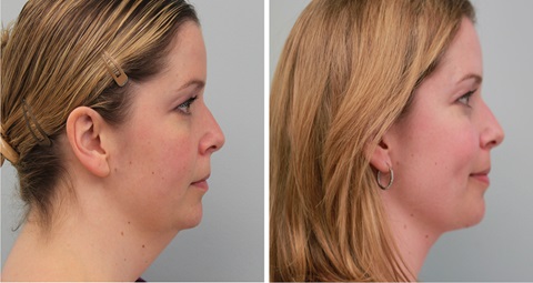 Chin Liposuction before and after