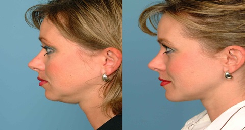 Chin Liposuction before and after