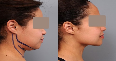Chin Liposuction before and after