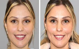 Dimple creation before and after