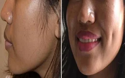Before and after of Dimple creation