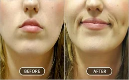 Dimple creation before and after