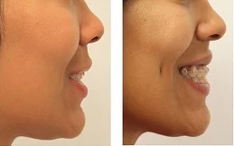 Befor and after of Dimple creation