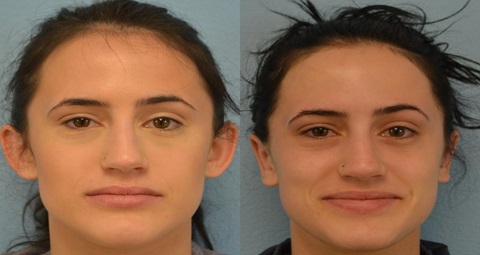 Ear Cosmetic Surgery before and after