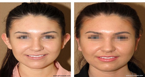 Ear Cosmetic Surgery before and after