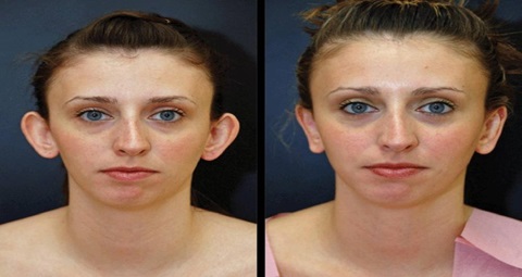 Ear Cosmetic Surgery before and after