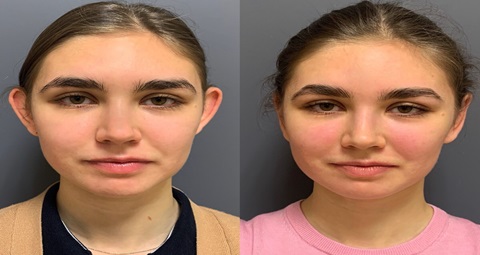 Ear Cosmetic Surgery before and after