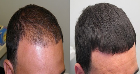 GFC Hair Treatment before and after