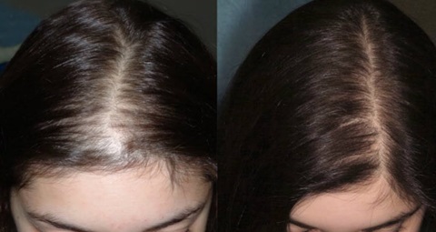 GFC Hair Treatment before and after