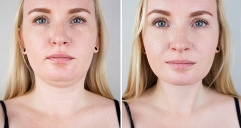 Jawline Filler Injections before and after