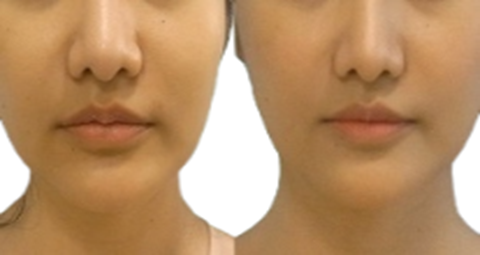 Lip Reduction Surgery before and after