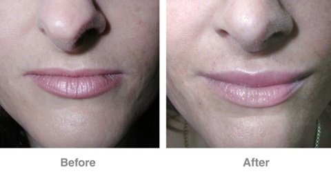Lip Reduction surgery in Dubai