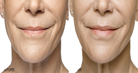 Lip Reduction Surgery before and after