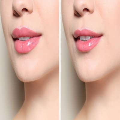 Lip Reduction surgery in Dubai