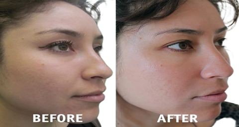 Vampire Facelift