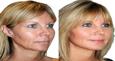 Vampire Facelift before and after