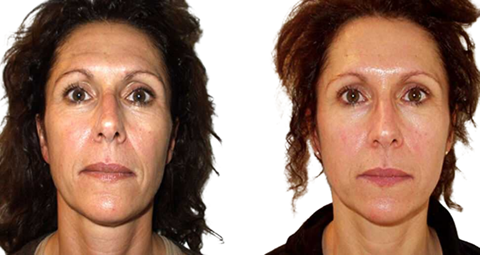 Vampire Facelift