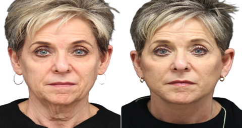 Vampire Facelift before and after