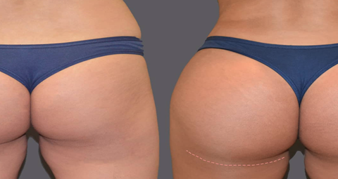 Brazilian Butt lift before and after