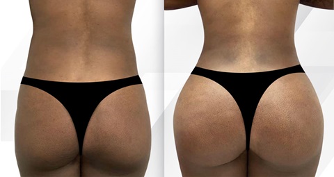 Brazilian Butt lift before and after