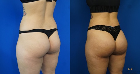 Brazilian Butt lift before and after