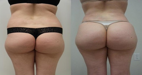 Brazilian Butt lift before and after