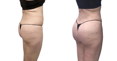 Buttock Lift before and after