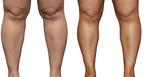 Calf Reduction before and after