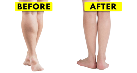 Calf Reduction before and after