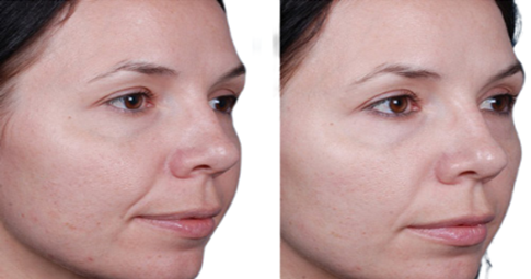 Chemical peels Before and After