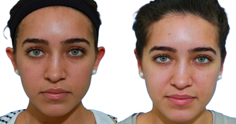 Chemical peels Before and After