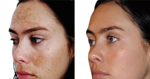 Chemical peels Before and After