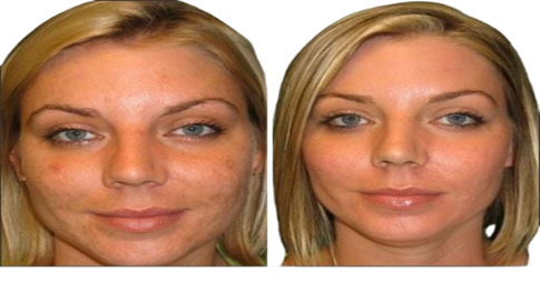 Chemical peels Before and After