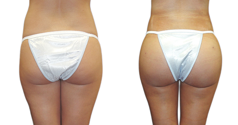 French Butt Lift before and after