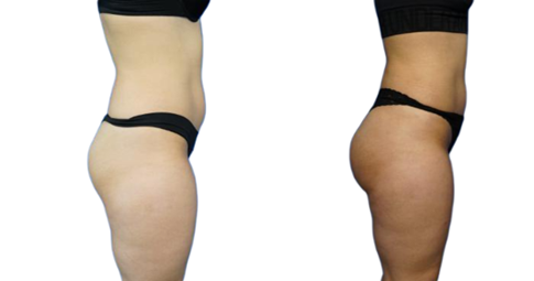 French Butt Lift before and after
