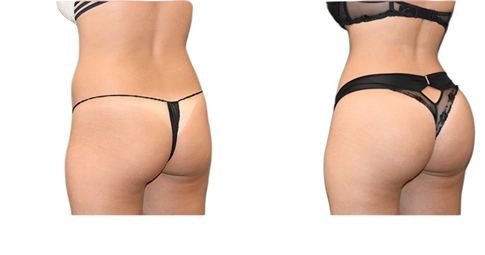 French Butt Lift before and after