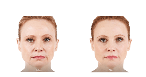 Juvederm treatment before and after