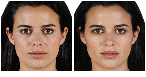Juvederm treatment before and after