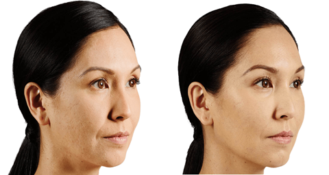 Juvederm treatment before and after