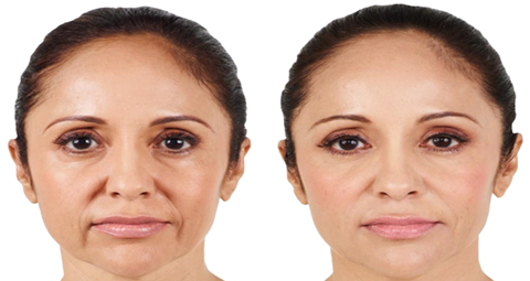 Juvederm treatment before and after