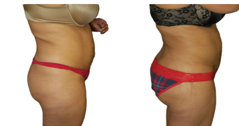 Buttock Lift before and after